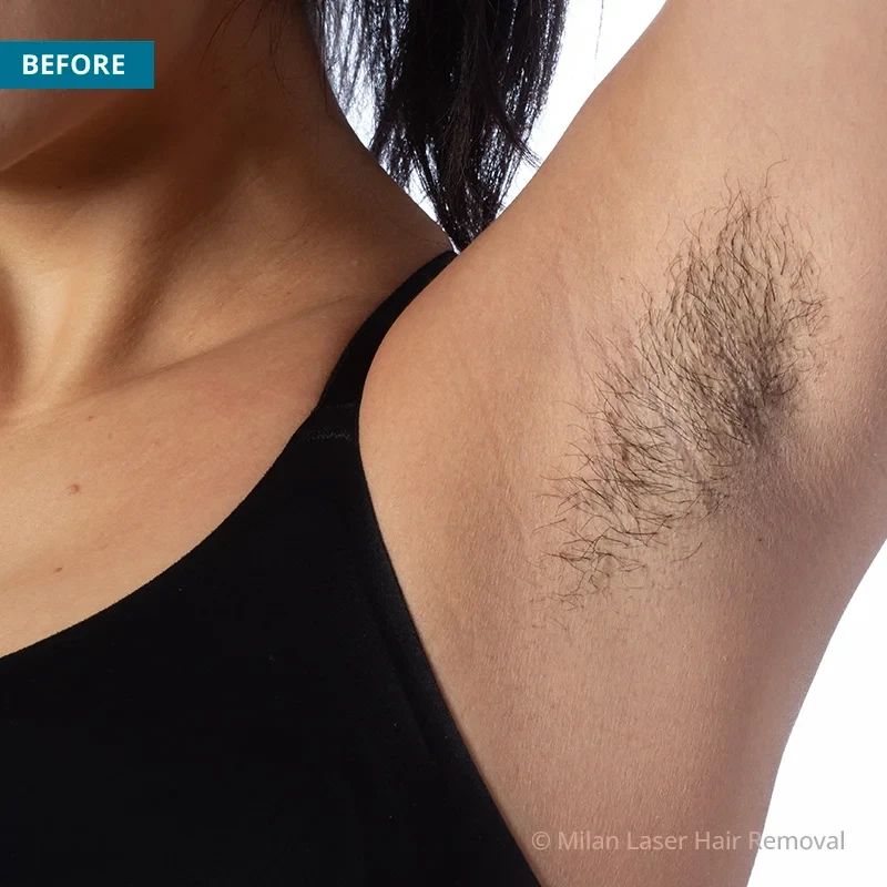Underarm Before & After Photos of Laser Hair Removal | Milan Laser in  Tri-Cities, TN